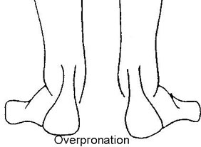 Over-Pronation